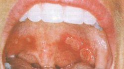 Σύνδρομο Αδαμαντιάδη – Behcet